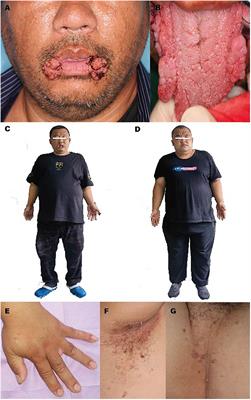 Case report: Rare oral manifestations in Cowden syndrome with PTEN mutation